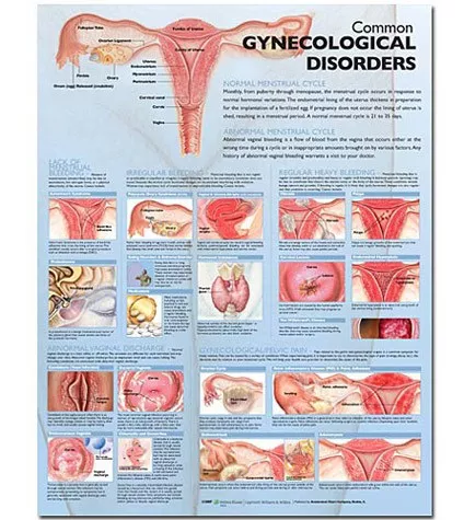 Common Gynecological Disorders Anatomical Chart