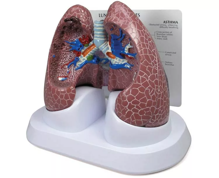 Diseased Lung Model