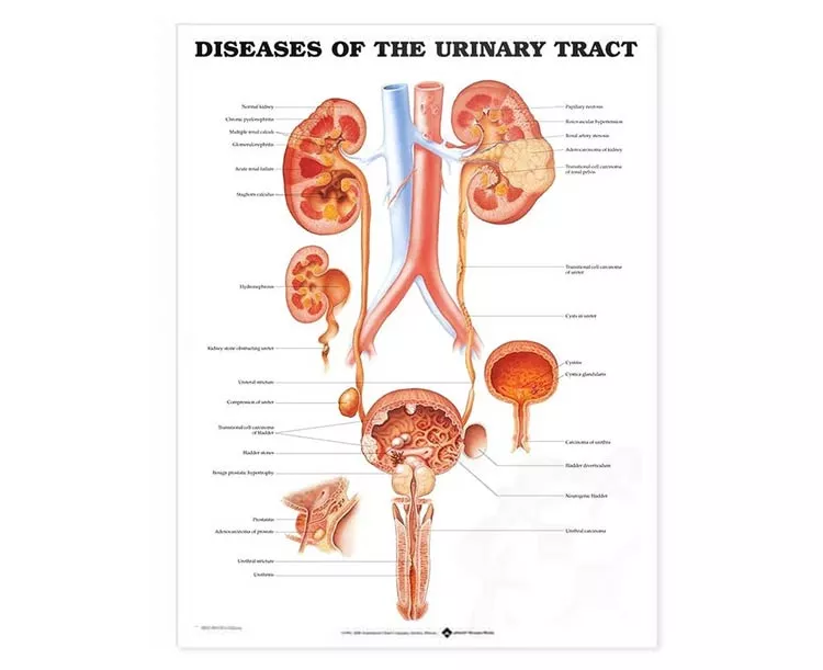 Diseases Of The Urinary Tract Laminated Anatomical Chart