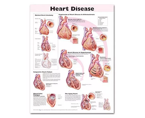 Heart Disease Anatomical Chart, 2nd Edition