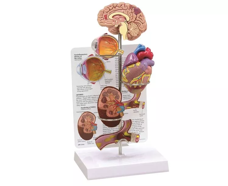 Hypertension Anatomy Model Set