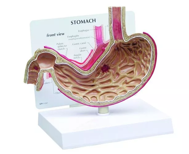 Stomach with Ulcers Model